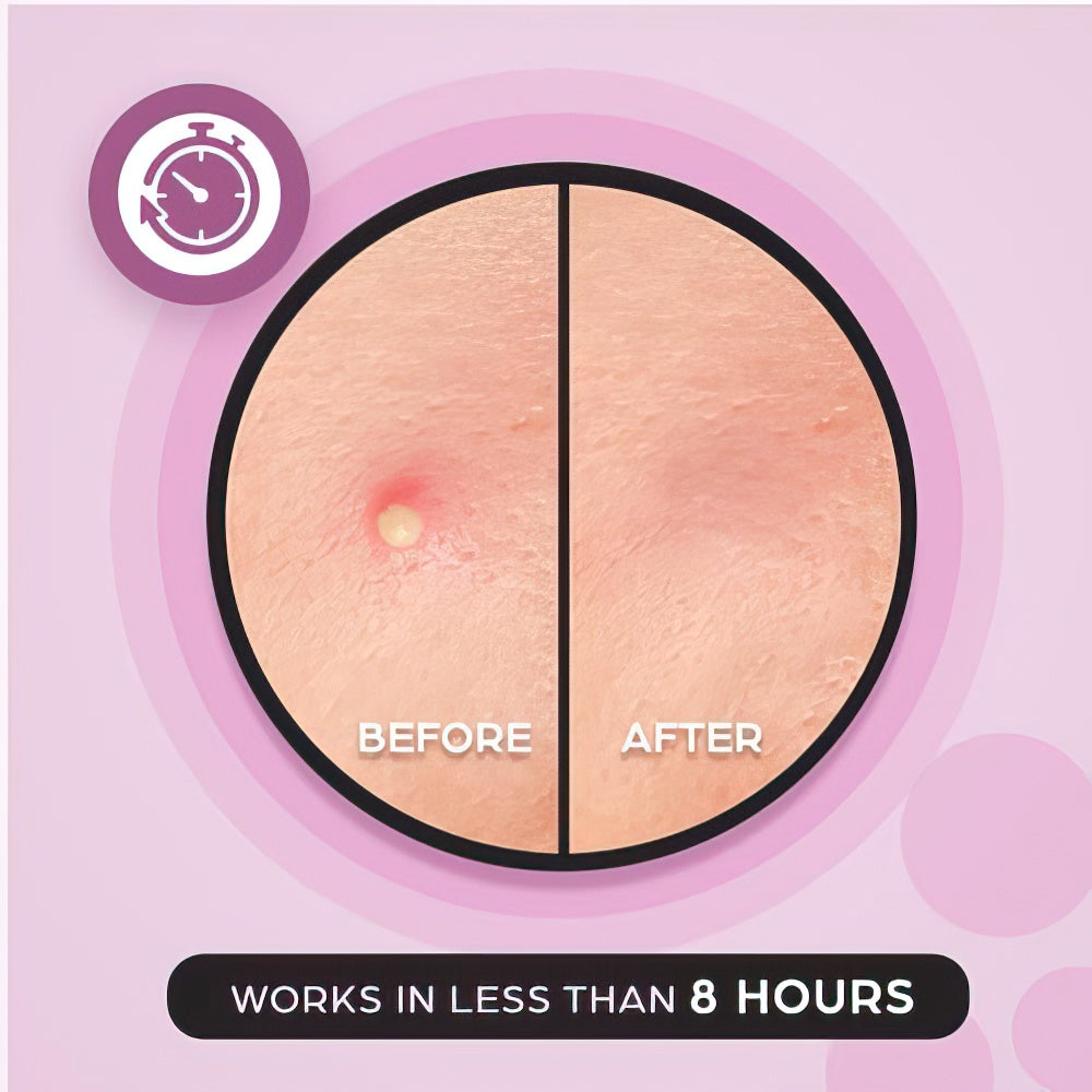 KEYCONCEPTS Acne Patches – 120 Count Hydrocolloid Pimple Patches with Tea Tree Oil