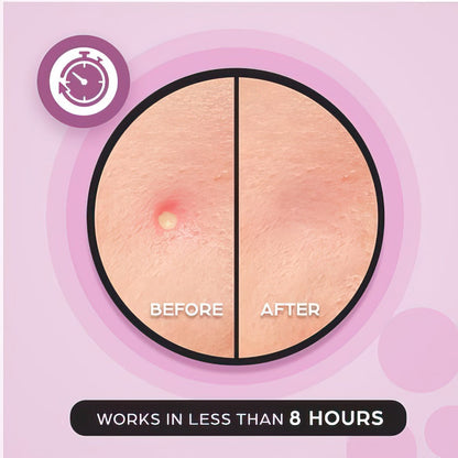 KEYCONCEPTS Acne Patches – 120 Count Hydrocolloid Pimple Patches with Tea Tree Oil