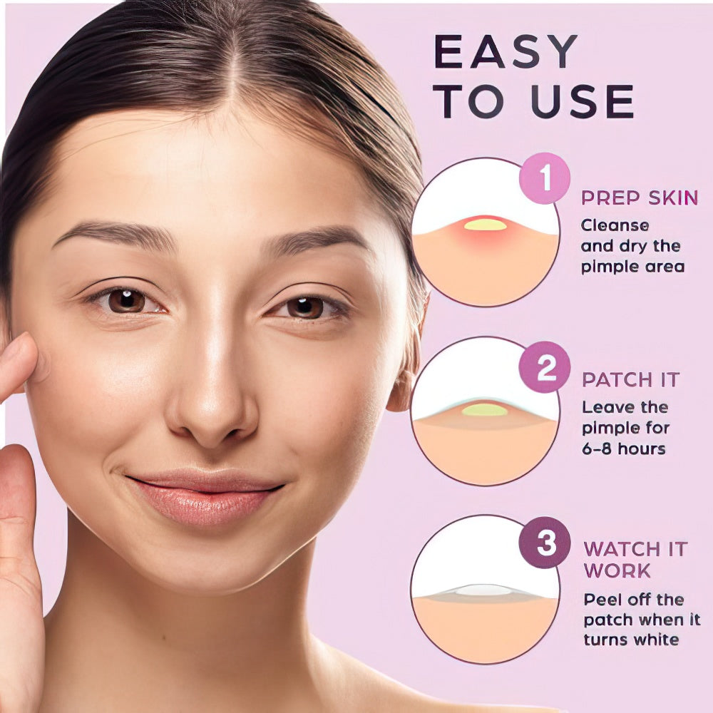 KEYCONCEPTS Acne Patches – 120 Count Hydrocolloid Pimple Patches with Tea Tree Oil